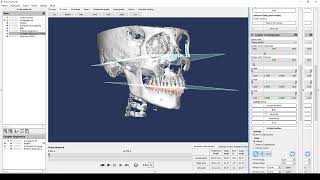 16 Building an occlusal plane [upl. by Nilats928]