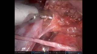 Difficult case03 XiParaaortic LN dissection 16a2int 16b1int [upl. by Enait]