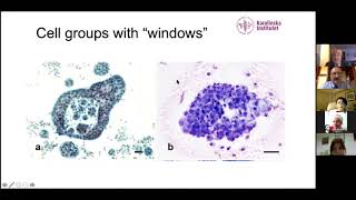 Cytological diagnosis of mesothelioma myth or facts  and what about mesotheliomainsitu [upl. by Ruben57]