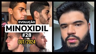 EVOLUÇÃO DE INSCRITOS  MINOXIDIL 28 [upl. by Naek]