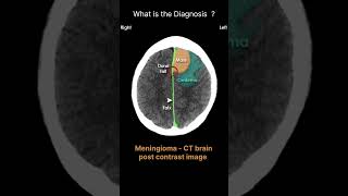 Meningioma CT brainpost contrast image Acute CT Brain Intracranial masses75radiologychannel007 [upl. by Stefa551]