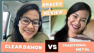 Clear Self ligating braces VS traditional metal braces Things I wish I knew before getting damon [upl. by Lorusso]