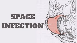 Dental Space Infection  Cellulitis  Ludwig Angina  Canine  Buccal Space [upl. by Holey]