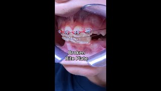 Braces Emergency  Broken Bite Plate  Broken Orthodontic appliance  Tooth Time Family Dentistry [upl. by Jillane479]