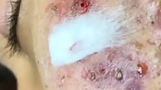 LARGE whitehead Extraction from Cheeks so good  Best Pimple Popping Videos [upl. by Rriocard]