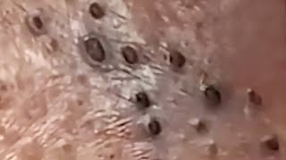 Blackheads amp Whiteheads Satisfying Removal 0164 [upl. by Naashom]