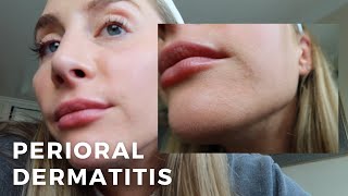 Perioral Dermatitis What to Know Skincare  An Estheticians Experience [upl. by Heppman]