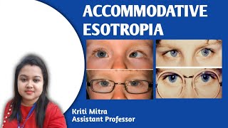 ACCOMMODATIVE ESOTROPIA [upl. by Yelhak335]