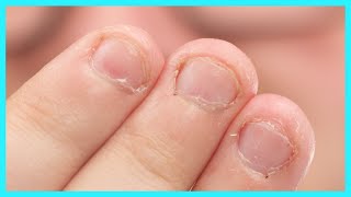 Fix Bitten Nails and Avoid Allergies with My Hack [upl. by Adnaerb]