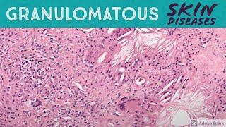 Granulomatous Skin Diseases 101 Dermpath Basics for Dermatology Pathology amp USMLE [upl. by Georgianna697]