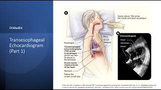 Transesophageal Echocardiogram TEE Indications and Contraindications [upl. by Benedicta]