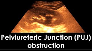 Pelviureteric Junction PUJ obstruction  dilatation of the pelvicaliceal system  Hydronephrosis [upl. by Hajile2]