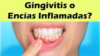 COMO CURAR LA GINGIVITIS Remedios Caseros Para La Gingivitis y Encías Inflamadas [upl. by Nya350]