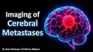 Imaging of cerebral metastases [upl. by Januisz]