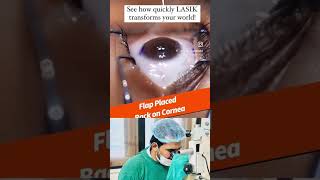 Lasik laser within seconds lasik squint eyecare doctor eyeclinic mbbs squintcorrection eyes [upl. by Aiuqram193]