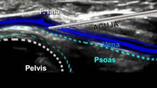 ACCESO VENOSO FEMORAL EN EL NEONATO Y LACTANTE MEDIANTE ECOGRAFÍA [upl. by Alleuqcaj]