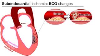 Ischemia 47  UA and NTSEMI [upl. by Strephonn64]