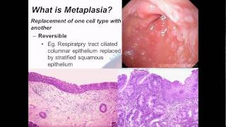 Pathophysiology 5 cell adaptations [upl. by Allin439]