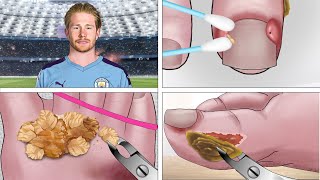 ASMR Help Kevin De Bruyne take care of his toenails and remove ingrown toenails [upl. by Luedtke219]