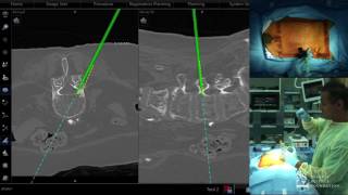 Live Demo Navigation Assisted Percutaneous Pedicle Screw Placement  Sheeraz Qureshi MD [upl. by Antin]