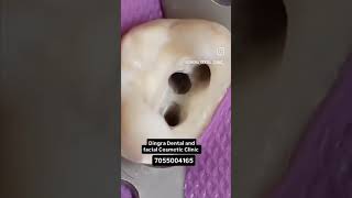 rootcanaltreatment viralvideo teeth trending dentist toothache [upl. by Lem]