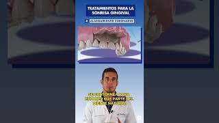 El ALARGAMIENTO de CORONA dental  Una SOLUCIÓN para la sonrisa GINGIVAL [upl. by Yelra]