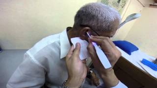 Doctors eye view Impacted earwax removal with lighted ear curette [upl. by Gievlos]