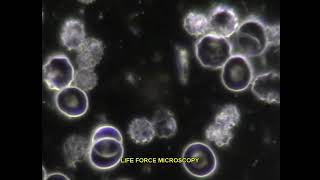 LIVE BLOOD ANALYSIS ECHINOCYTES BURR CELLS [upl. by Aro155]