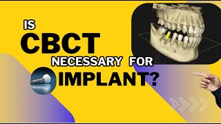 Radiographic Imaging for dental implant CBCT for Dental implant [upl. by Ellehcil]