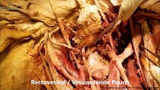 BLADDER Ligaments Detrussor TRIGONE DUCTUS URETER Clinicals – Sanjoy Sanyal – Proceum [upl. by Alika]