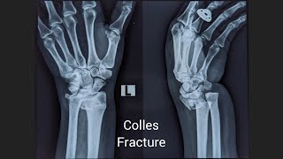 Colles Fracture by Dr Bone [upl. by Marguerite772]