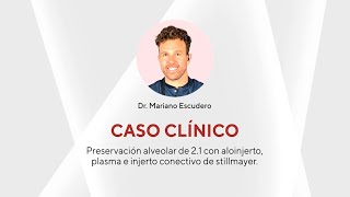 Caso Preservación alveolar de 21 con aloinjerto plasma e injerto conectivo  Dr Mariano Escudero [upl. by Seligman]