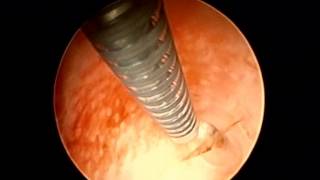 Vidéo  pose dun implant tubaire ESSURE unilatéral gauche sous hystéroscopie [upl. by Hgielrahc165]