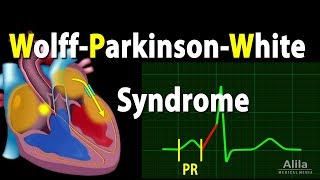 WolffParkinsonWhite Syndrome Pathophysiology PreExcitation and AVRT Animation [upl. by Baese820]