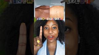 How to Treat Tinea Versicolor skincare tineaversicolor [upl. by Herm]