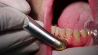 gingivectomia y gingivoplastia con laserDr joaquin garcía rodriguezAlgeciras [upl. by Landrum]