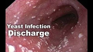 How to Get Rid of A YEAST INFECTION In 12 HOURS [upl. by Inman]