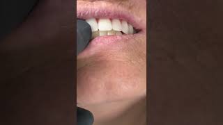 Before making full mouth implants zirconia [upl. by Hedges]