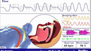 Understanding Sleep Disordered Breathing [upl. by Aerdnac]