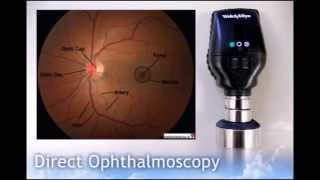 Direct Ophthalmoscopy [upl. by Troyes]