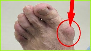 Bunion Removal  How To Get Rid Of Bunions Naturally  Shrink Bunions Naturally [upl. by Attirb]