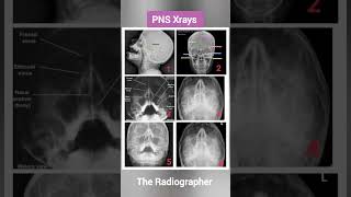 PNS Xrays and their Positioning  pnsxray xrays radiography [upl. by Paderna]