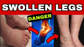 SWOLLEN LEGS  5 WARNING SIGNS and 9 Causes of Swelling in Feet and Legs [upl. by Shalne471]