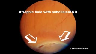 Scleral Depression with DIYretCAM Atrophic hole with Subclinical Retinal Detachment [upl. by Tynan]