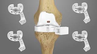 iTotal PS Knee Replacement Surgical Technique Animation  Conformis [upl. by Eltotsira]