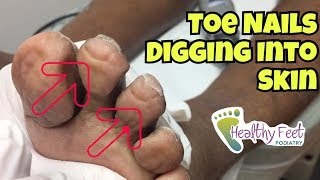 Nails Curling Into Toes  Nail Trimming for Diabetic Ingrown Nails at the Ends of the Toe [upl. by Nylodnewg285]