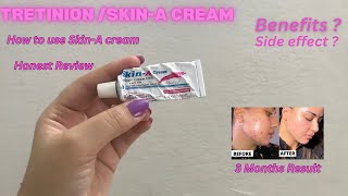 Skin A Cream Review  Acne Treatment at home  How to Use Tretinoin  Tretinoin Cream [upl. by Leizahaj]