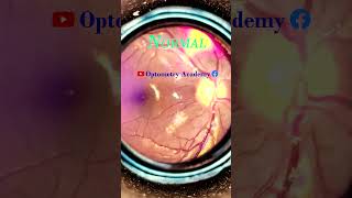 Normal fundus  Normal Retina  Smartphone Fundus Videography  Fundus Photography  Short Video 61 [upl. by Ahsinyar]