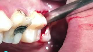 Third Molar Extraction [upl. by Rihaz]