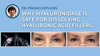 How Hyaluronidase Injections to Remove Filler is Done Safely [upl. by Amye]